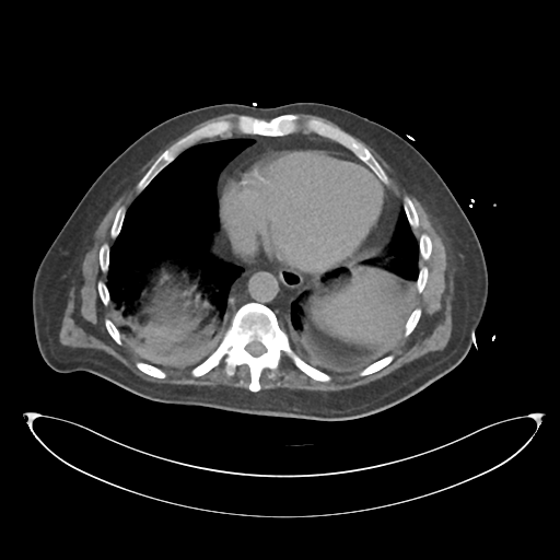 File:Obstructive pyelonephritis (Radiopaedia 46411-50844 Axial non-contrast 10).png