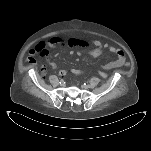 File:Obstructive pyelonephritis (Radiopaedia 46411-50844 Axial non-contrast 57).png