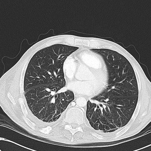 File:Obstructive superior vena cava tumor thrombus (Radiopaedia 28046-28306 Axial lung window 33).jpg