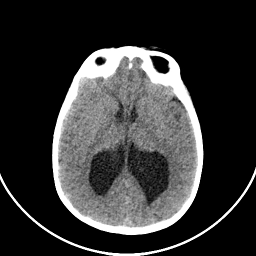 Occipital encephalocele (Radiopaedia 87339-103636 Axial non-contrast 45).jpg