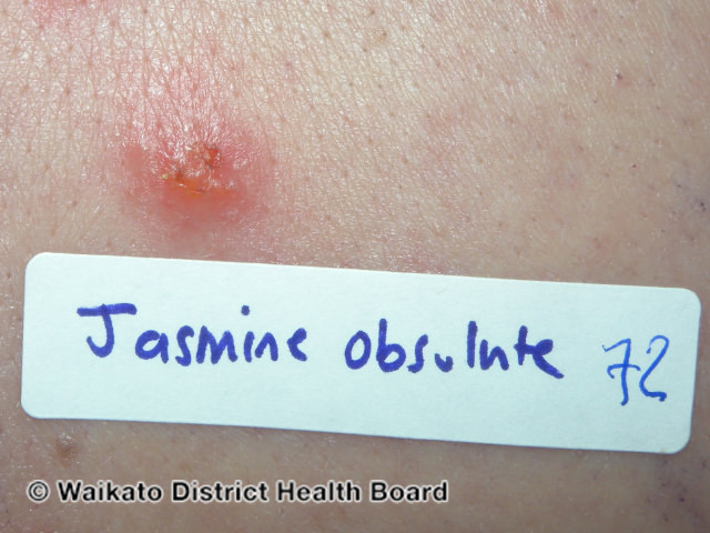 File:Positive patch tests to jasmine absolute oil (DermNet NZ jasmine-positive-patch).jpg