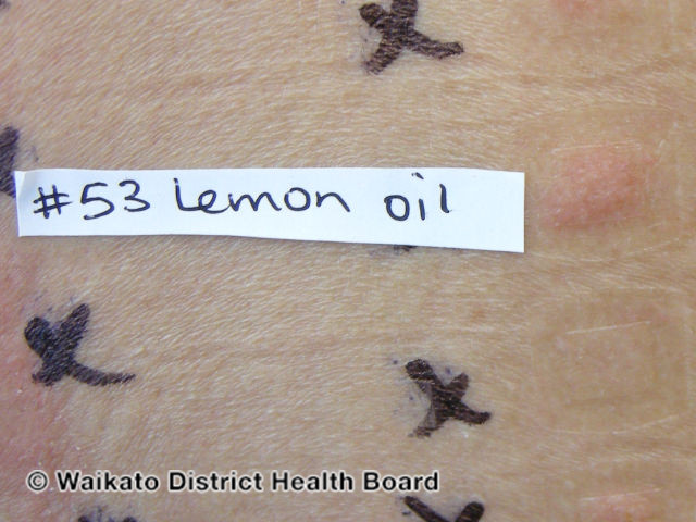 File:Positive patch tests to lemon oil (DermNet NZ lemon-oil-positive-patch).jpg