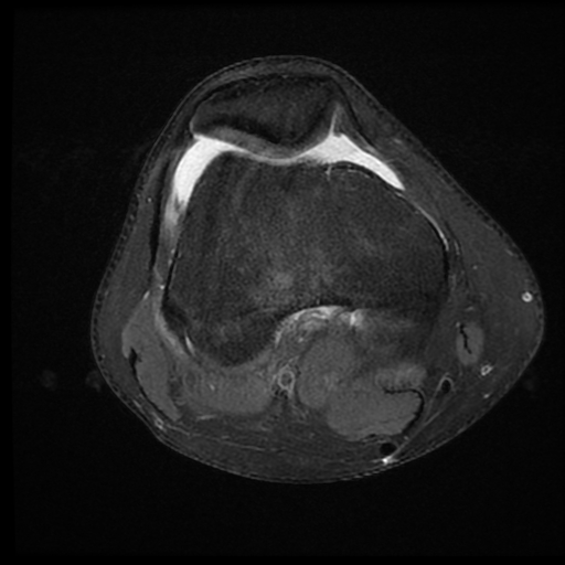 File:ACL acute full thickness tear - deep lateral femoral sulcus sign (Radiopaedia 38594-40740 Axial PD fat sat 10).jpg