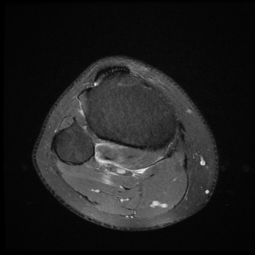 File:ACL acute full thickness tear - deep lateral femoral sulcus sign (Radiopaedia 38594-40740 Axial PD fat sat 23).jpg