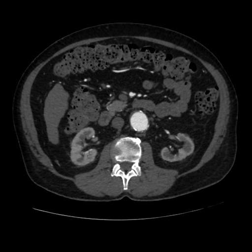 File:Abdominal aortic aneurysm (Radiopaedia 57318-64259 Axial C+ arterial phase 32).jpg