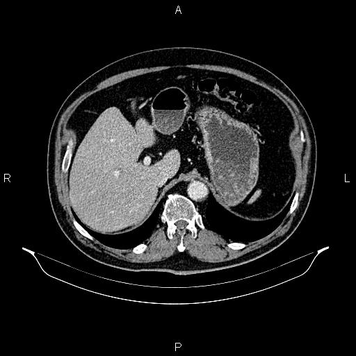 Abdominal aortic aneurysm (Radiopaedia 83094-97462 Axial renal cortical phase 75).jpg