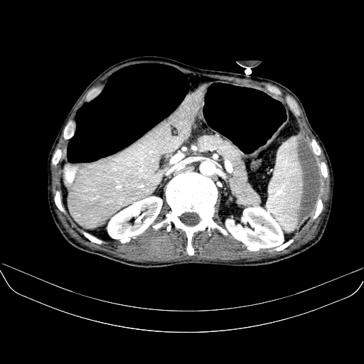 File:Abdominal collection due to previous cecal perforation (Radiopaedia 80831-94320 Axial C+ portal venous phase 64).jpg