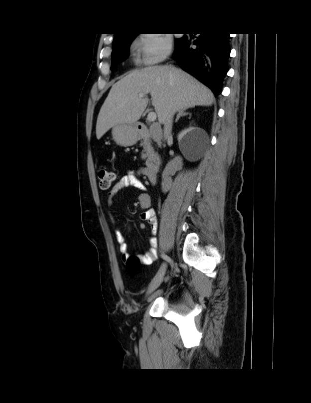 Abdominal lymphoma - with sandwich sign (Radiopaedia 53486-59492 Sagittal C+ portal venous phase 50).jpg