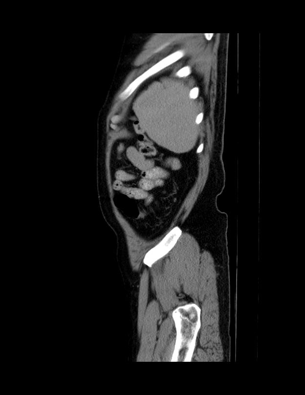 Abdominal lymphoma - with sandwich sign (Radiopaedia 53486-59492 Sagittal C+ portal venous phase 6).jpg