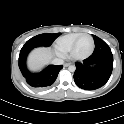 File:Abdominal multi-trauma - devascularised kidney and liver, spleen and pancreatic lacerations (Radiopaedia 34984-36486 Axial C+ delayed 3).png