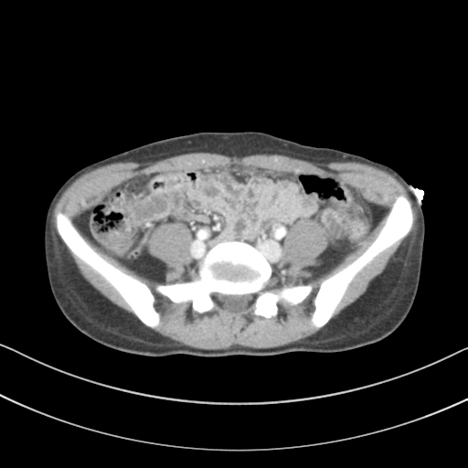 Abdominal multi-trauma - devascularised kidney and liver, spleen and pancreatic lacerations (Radiopaedia 34984-36486 Axial C+ portal venous phase 57).png