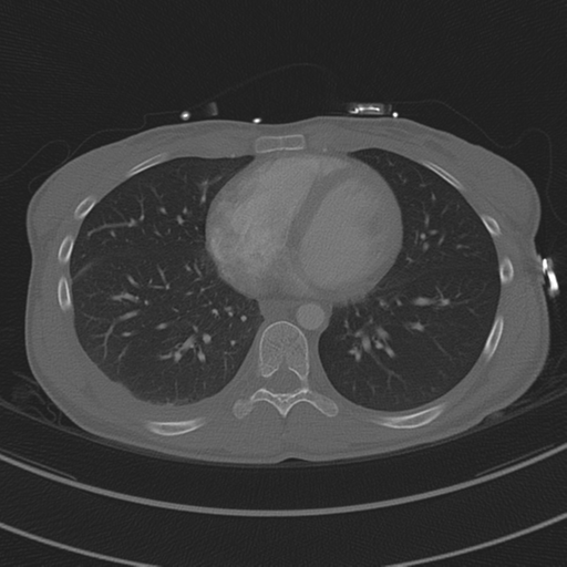 File:Abdominal multi-trauma - devascularised kidney and liver, spleen and pancreatic lacerations (Radiopaedia 34984-36486 I 57).png