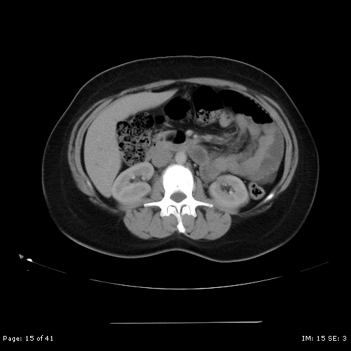 File:Abdominal wall endometriosis (Radiopaedia 25723-25885 Axial C+ portal venous phase 15).jpg