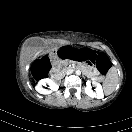File:Abdominal wall hematoma with active bleeding (Radiopaedia 83915-99117 Axial C+ portal venous phase 24).jpg