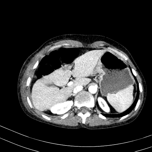 Abdominal wall hematoma with active bleeding (Radiopaedia 83915-99117 Axial renal cortical phase 1).jpg