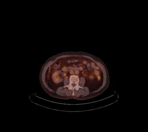 File:Abdominal wall metastasis from colorectal carcinoma (Radiopaedia 31016-31719 C 63).jpg
