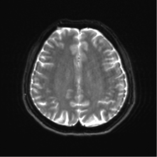 Abducens nerve palsy (Radiopaedia 51069-56648 Axial DWI 18).png