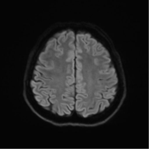 Abducens nerve palsy (Radiopaedia 51069-56648 Axial DWI 47).png