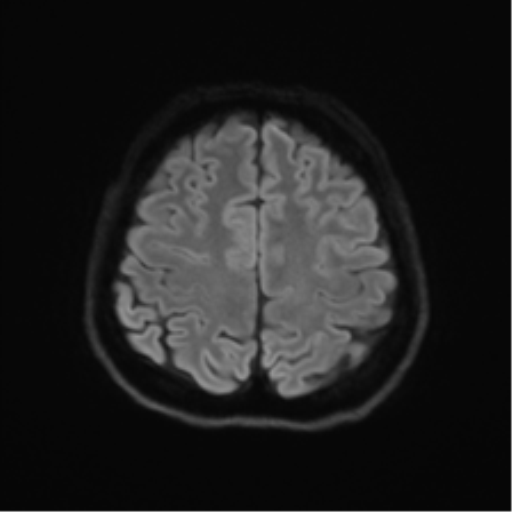 Abducens nerve palsy (Radiopaedia 51069-56648 Axial DWI 48).png