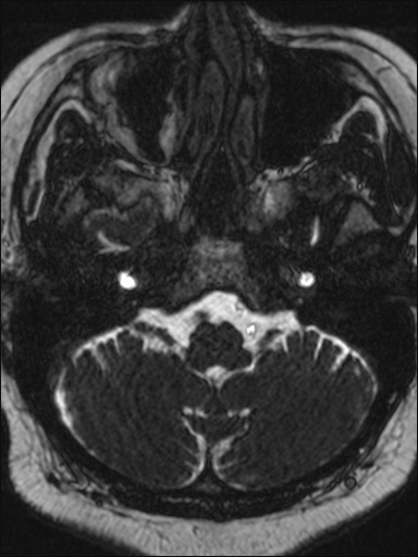 File:Abducens nerve palsy (Radiopaedia 57084-63976 Axial T2 ciss 3d 13).jpg