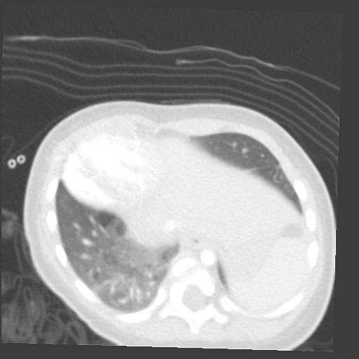 File:Aberrant left pulmonary artery (pulmonary sling) (Radiopaedia 42323-45435 Axial lung window 31).jpg