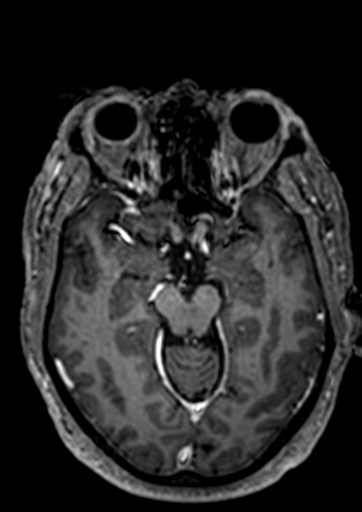 Accessory middle cerebral artery (Radiopaedia 73114-83828 Axial T1 C+ 77).jpg