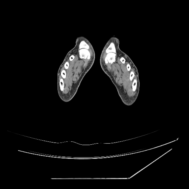 Accessory soleus muscle (Radiopaedia 61069-68943 Axial non-contrast 93).jpg