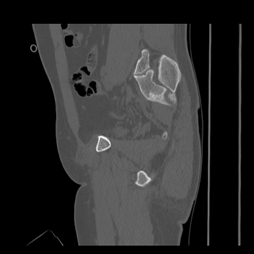 Acetabular and ilial fractures (Radiopaedia 59084-66378 Sagittal bone window 38).jpg