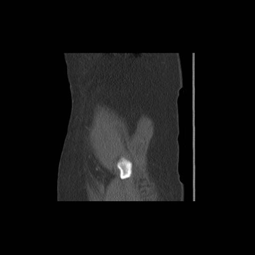 File:Acetabular fracture (Radiopaedia 13193-13212 Sagittal bone window 2).jpg