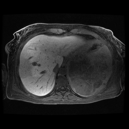 Acinar cell carcinoma of the pancreas (Radiopaedia 75442-86668 Axial late phase (~30 mins) 113).jpg