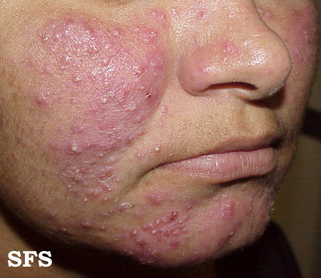 File:Acne Rosacea (Dermatology Atlas 8).jpg