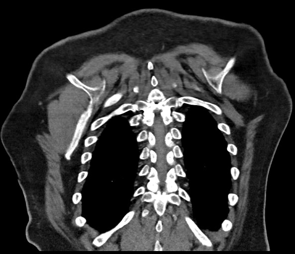 Acromioclavicular joint cyst (Radiopaedia 58455-65610 Coronal C+ arterial phase 121).jpg