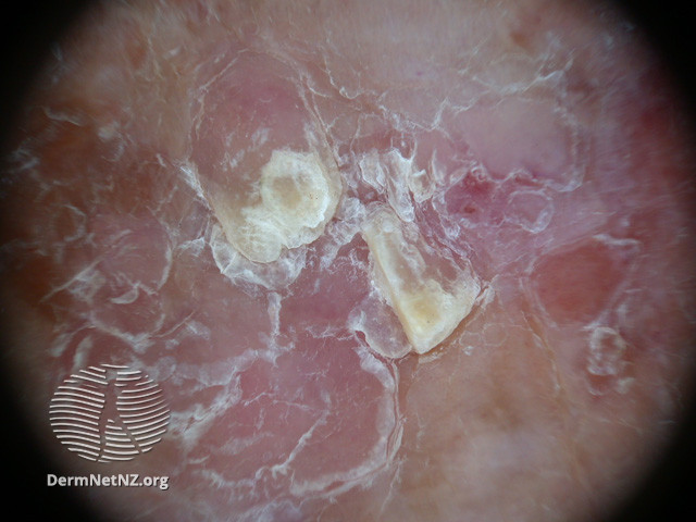 File:Actinic Keratoses affecting the legs and feet (DermNet NZ lesions-ak-legs-505).jpg