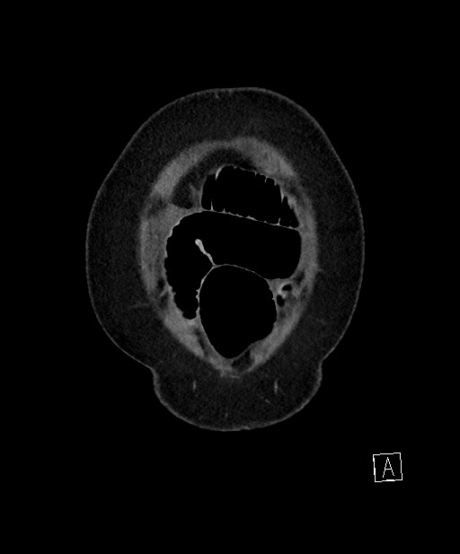 Active Crohn disease (Radiopaedia 59394-66750 Coronal C+ portal venous phase 8).jpg