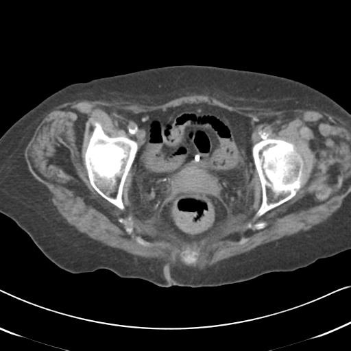 Active bleeding from duodenal ulcer with embolization (Radiopaedia 34216-35481 Axial non-contrast 62).png