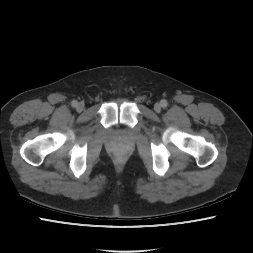 File:Active colonic bleed on CT (Radiopaedia 49765-55025 Axial C+ delayed 84).jpg