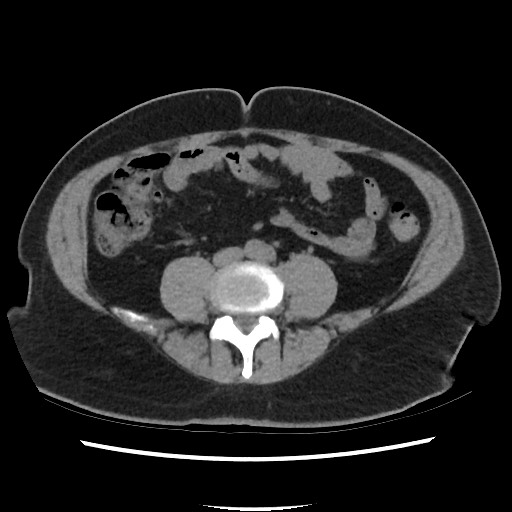 Active colonic bleed on CT (Radiopaedia 49765-55025 Axial non-contrast 51).jpg