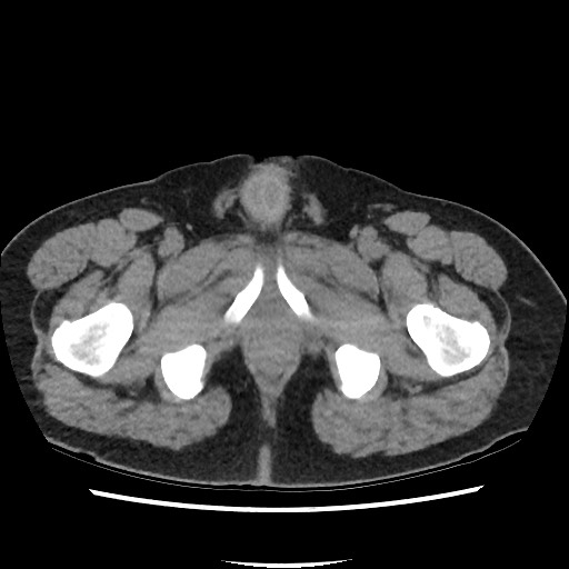 Active colonic bleed on CT (Radiopaedia 49765-55025 Axial non-contrast 88).jpg