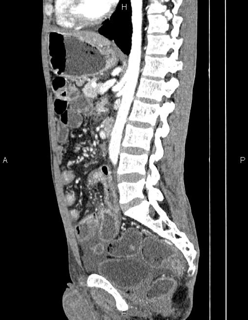 Active crohn disease (Radiopaedia 87133-103397 Sagittal C+ arterial phase 50).jpg