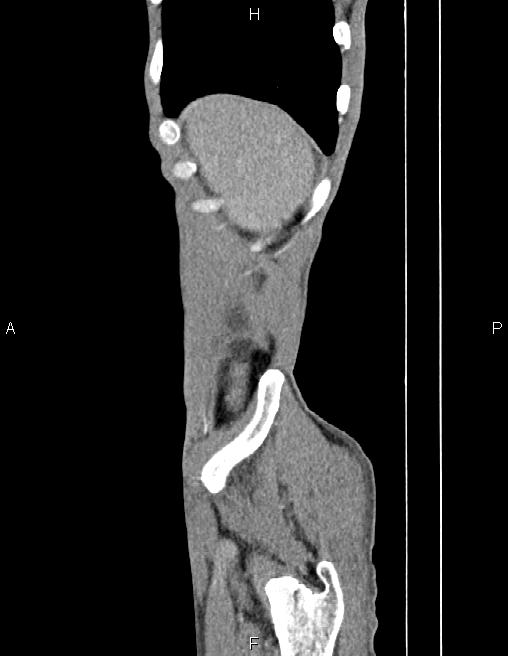 Active crohn disease (Radiopaedia 87133-103397 Sagittal C+ arterial phase 6).jpg