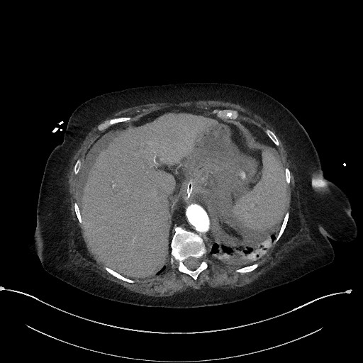 Active renal extravasation with large subcapsular and retroperitoneal hemorrhage (Radiopaedia 60975-68796 Axial C+ arterial phase 38).jpg