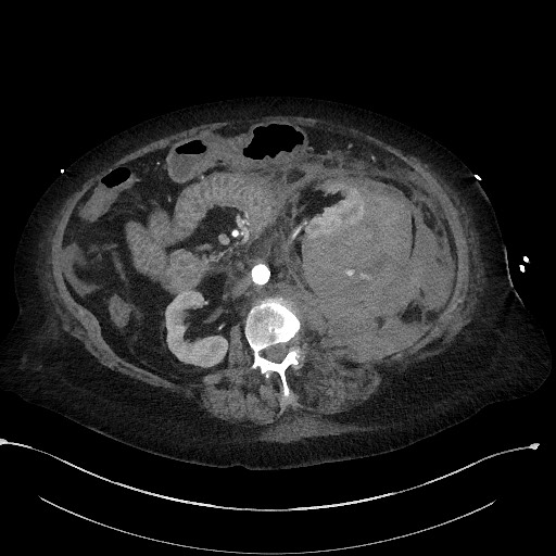Active renal extravasation with large subcapsular and retroperitoneal hemorrhage (Radiopaedia 60975-68796 Axial C+ arterial phase 86).jpg