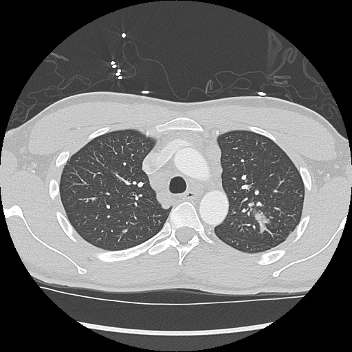 File:Active right ventricular cardiac sarcoidosis (Radiopaedia 55596-62101 Axial lung window 9).jpg