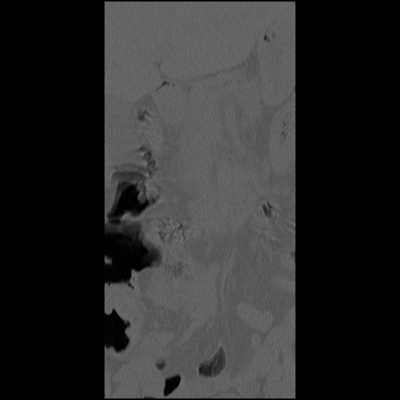 Acute Schmorl's node (Radiopaedia 83276-102365 Coronal bone window 2).jpg