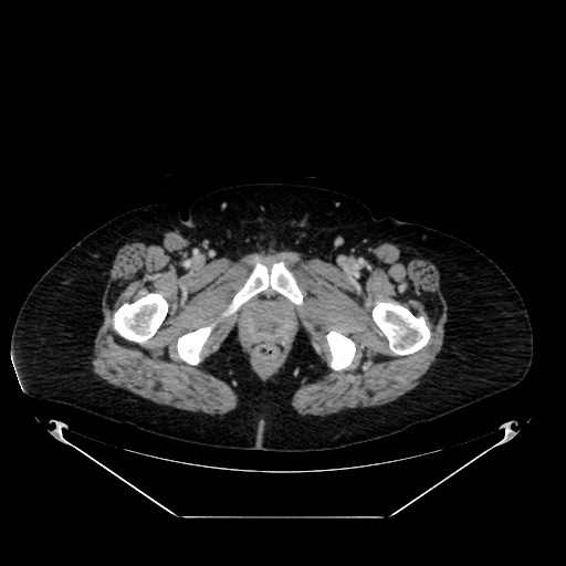 Acute appendicitis, heterotaxy syndrome (Radiopaedia 66884-76202 Axial C+ portal venous phase 134).jpg