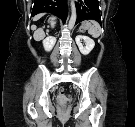 Acute appendicitis, heterotaxy syndrome (Radiopaedia 66884-76202 Coronal C+ portal venous phase 83).jpg