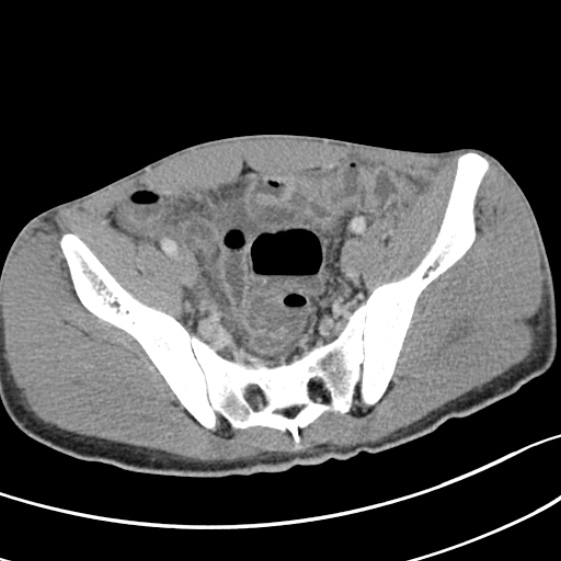 File:Acute appendicitis (Radiopaedia 32614-33572 Axial C+ portal venous phase 54).jpg
