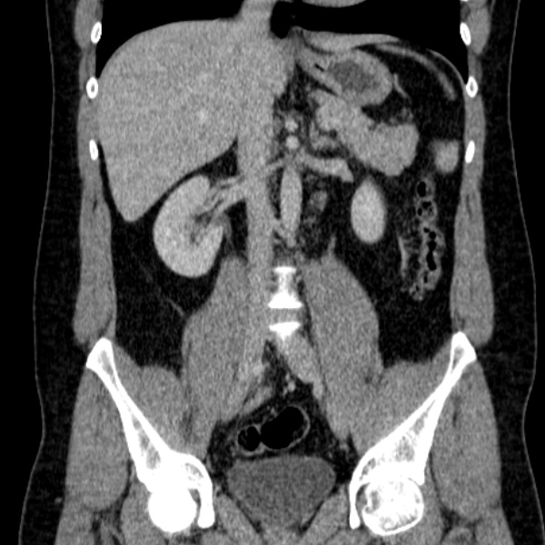 File:Acute appendicitis (Radiopaedia 38255-40270 Coronal C+ portal venous phase 47).jpg