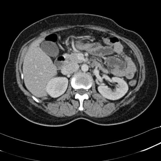 Acute appendicitis (Radiopaedia 48792-53822 Axial C+ portal venous phase 42).jpg