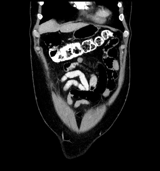 File:Acute appendicitis (Radiopaedia 77016-88960 Coronal C+ portal venous phase 26).jpg
